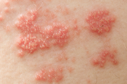 Herpes Pictures HD - Symptoms, Images, Photos and Pictures of Herpes