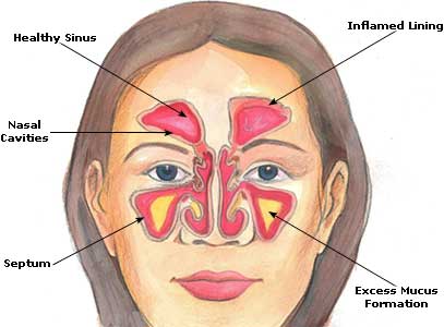 Steroids for treating sinus infection